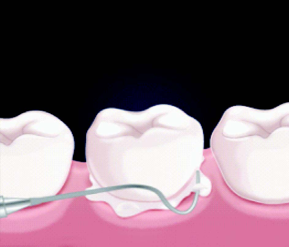 tempo_any-cem-implant04.jpg